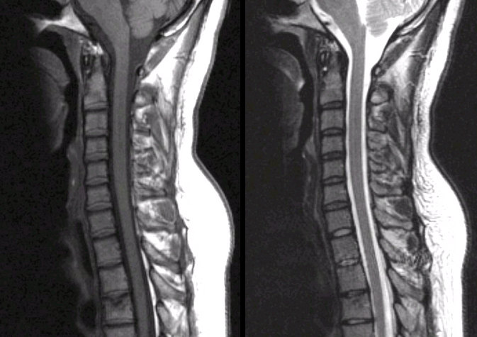 Normal Sagittal Lumbar Mri My Xxx Hot Girl